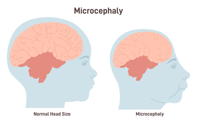 Microcefalie is een afwijking van het centrale zenuwstelsel waarbij de schedelomvang te klein is. Onderzoekers vermoeden dat het zika-virus een veroorzaker is van microcefalie.